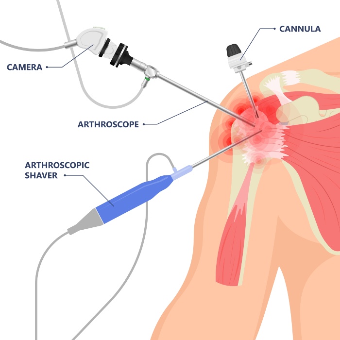 Shoulder-arthroscopy-melbourne Shoulder Arthroscopy Melbourne